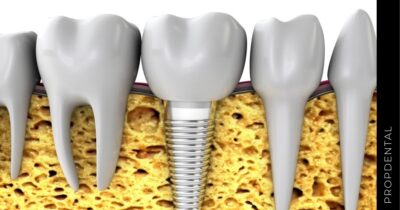 Cuánto dura un implante dental