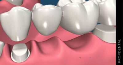 Alternativa a los implantes dentales