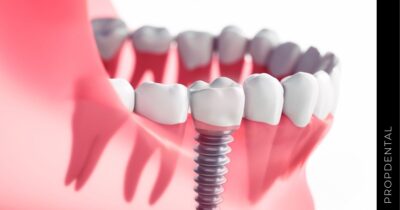 5 mitos del implante dental