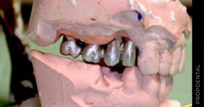 Implantología dental: Factores de riesgo