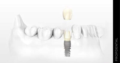 Implantes dentales:  Sistema NobelActive