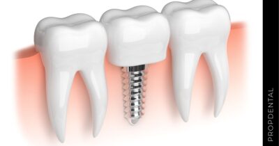 Fracaso de implantes dentales