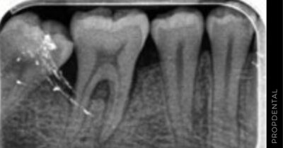 Regeneración periodontal de defectos infraóseos