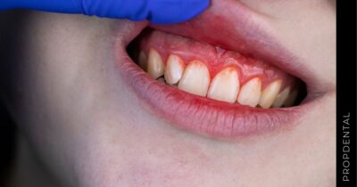 Defectos óseos periodontales