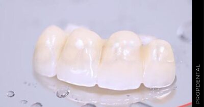 Puente sobre implantes dentales