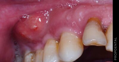 ¿Absceso dental y muerte?