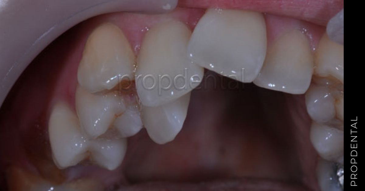 Apiñamiento dental