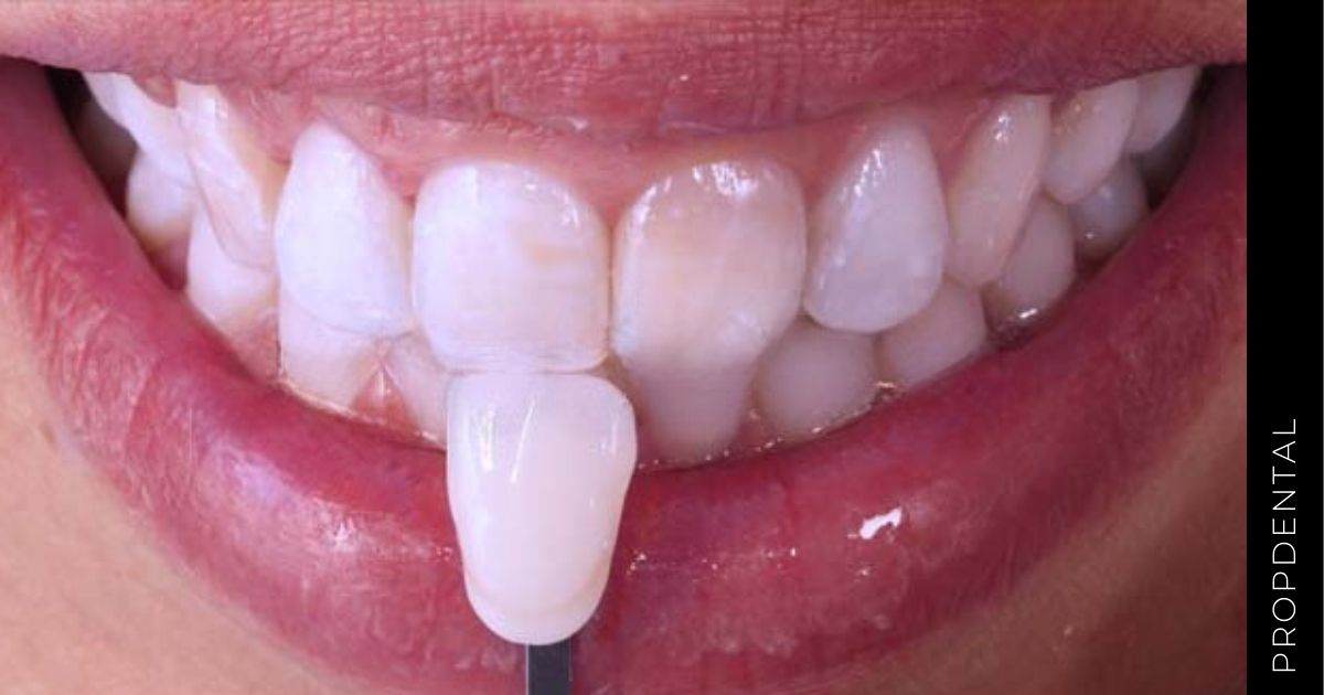 Blanqueamiento de dientes no vitales