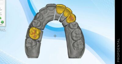 Cad cam dental