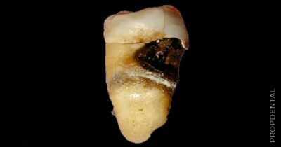 Caries radicular: ¿Qué es y cómo evitarla?