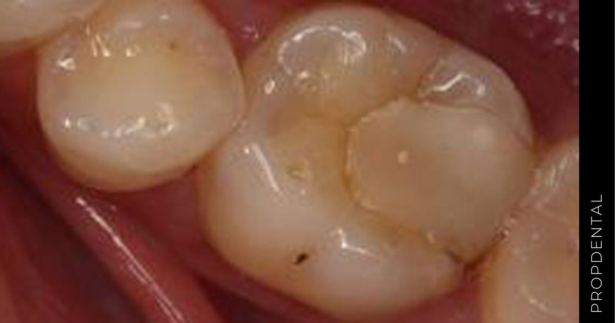 Caries secundaria