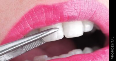 Carillas dentales E-MAX