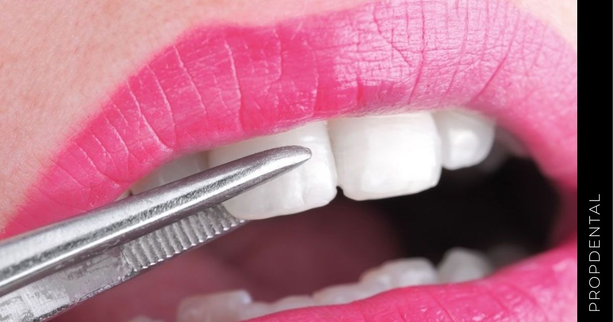Carillas dentales E-MAX