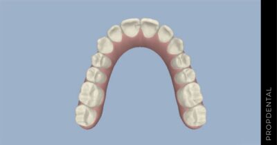 ClinCheck de Invisalign: ¿qué es y para qué sirve?