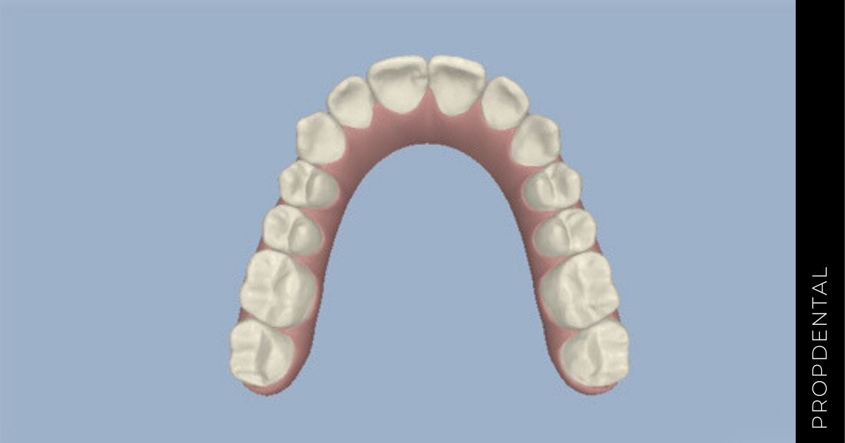 ClinCheck de Invisalign: ¿qué es y para qué sirve?
