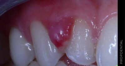 Absceso periapical