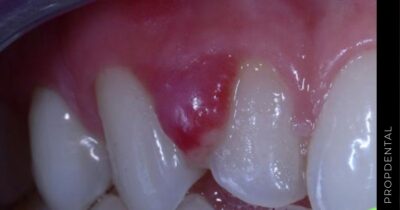 Como actuar ante un absceso dental