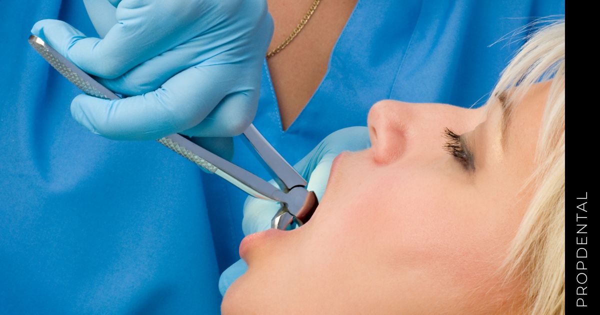 ¿Cómo se realiza la exodoncia del tercer molar?