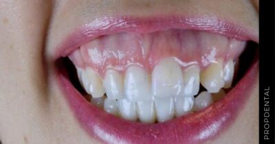 Como solucionar la sonrisa gingival