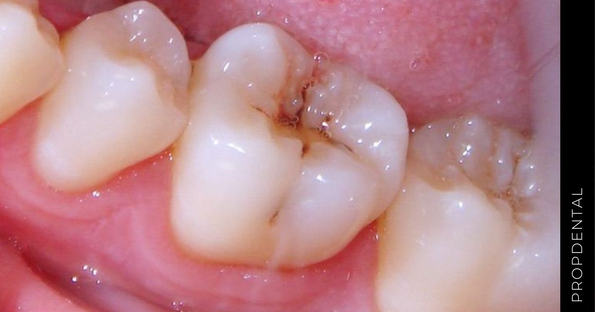Complicaciones de la caries dental