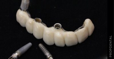 Complicaciones de los implantes dentales