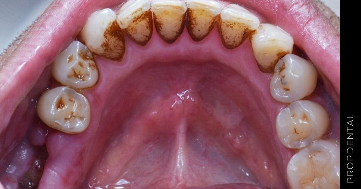 Complicaciones en exodoncias del tercer molar