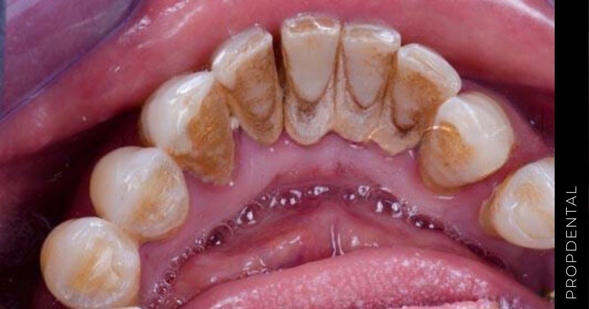 Consecuencias de una higiene oral insuficiente
