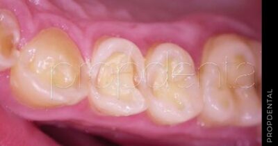 ¿Cuales son las causas y como solucionar la atrición dental?