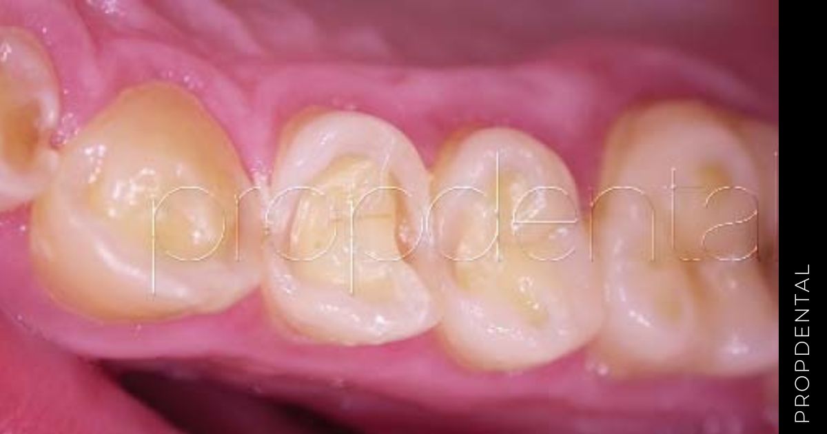 ¿Cuales son las causas y como solucionar la atrición dental?