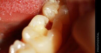 ¿Qué diferencia hay entre un empaste y una endodoncia?