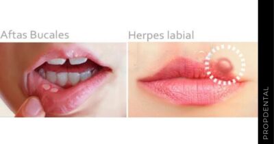Diferencias entre aftas bucales y herpes labial