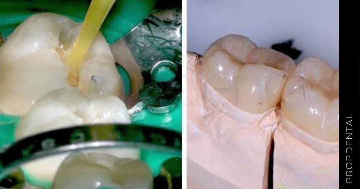 Diferencias entre empaste e incrustación dental