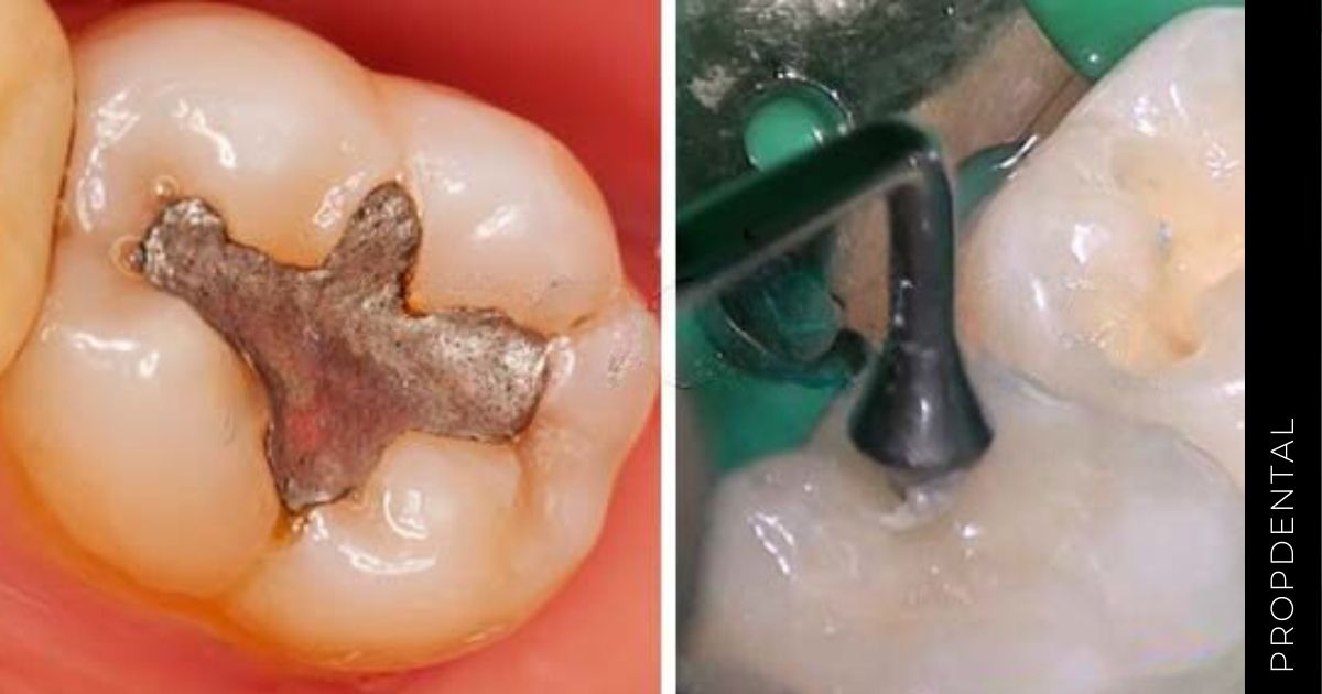 Diferencias entre empaste metálico y empaste de resina