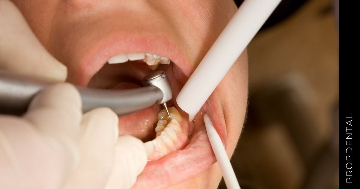 Dolor después de empaste dental