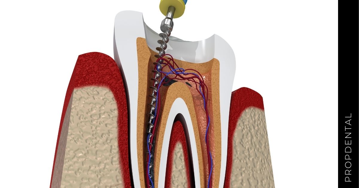Duele la endodoncia