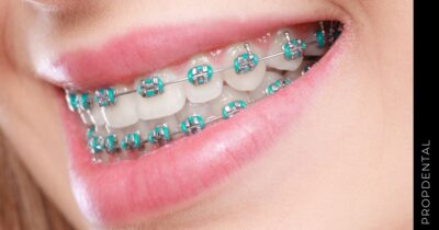 Duración tratamiento de ortodoncia | Preguntas frecuentes
