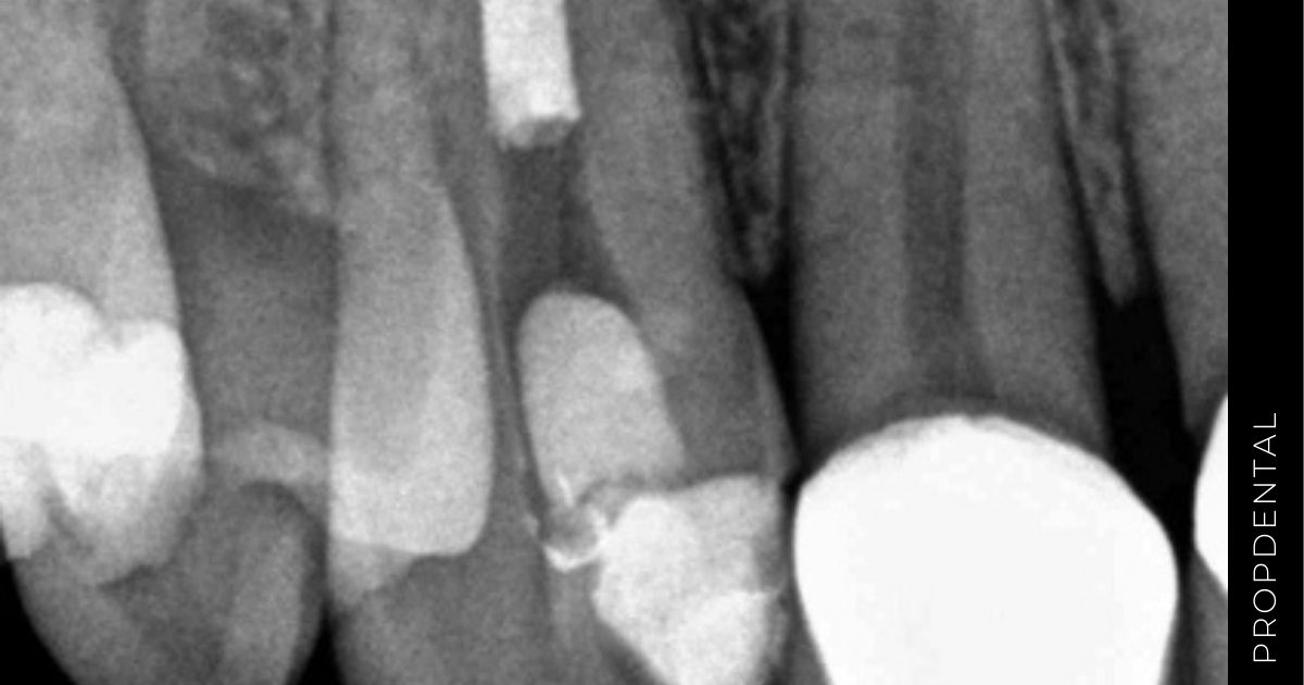 Endodoncia unirradicular