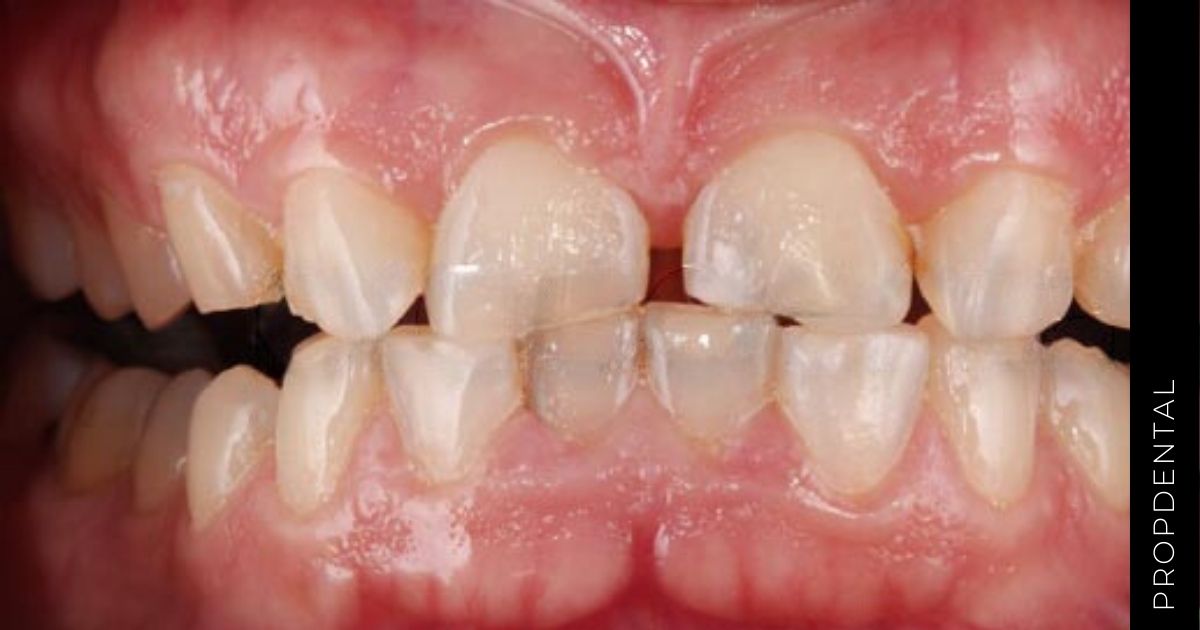 Erosión dental