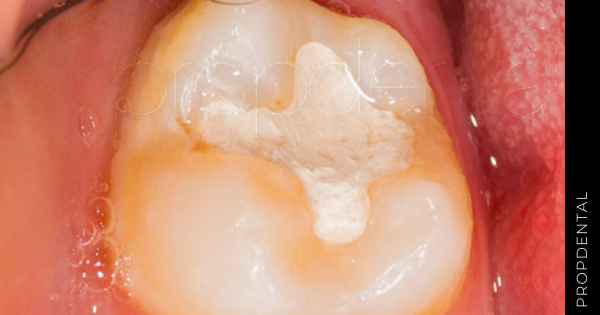 ¿Es normal sentir sensibilidad dental después de un empaste?