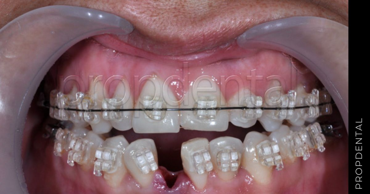 Extracción terapéutica ortodontica