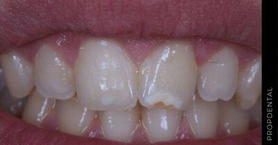 Hipoplasia dental en Barcelona: Causas, síntomas y tratamientos