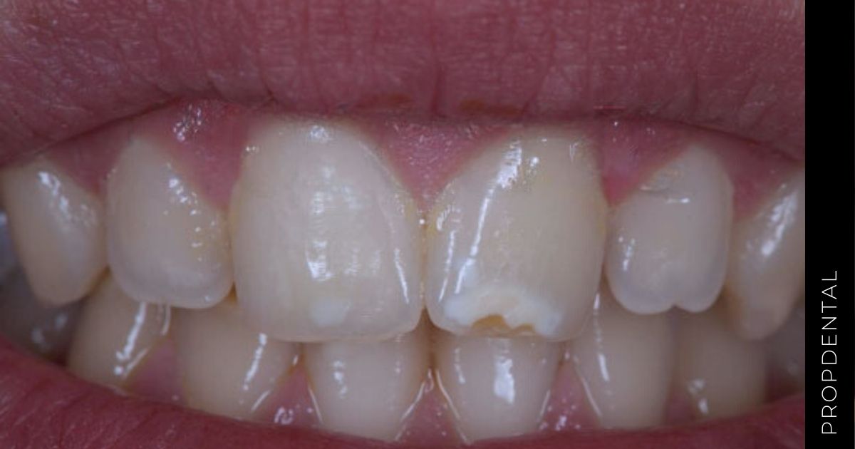 Hipoplasia dental o hipoplasia del esmalte