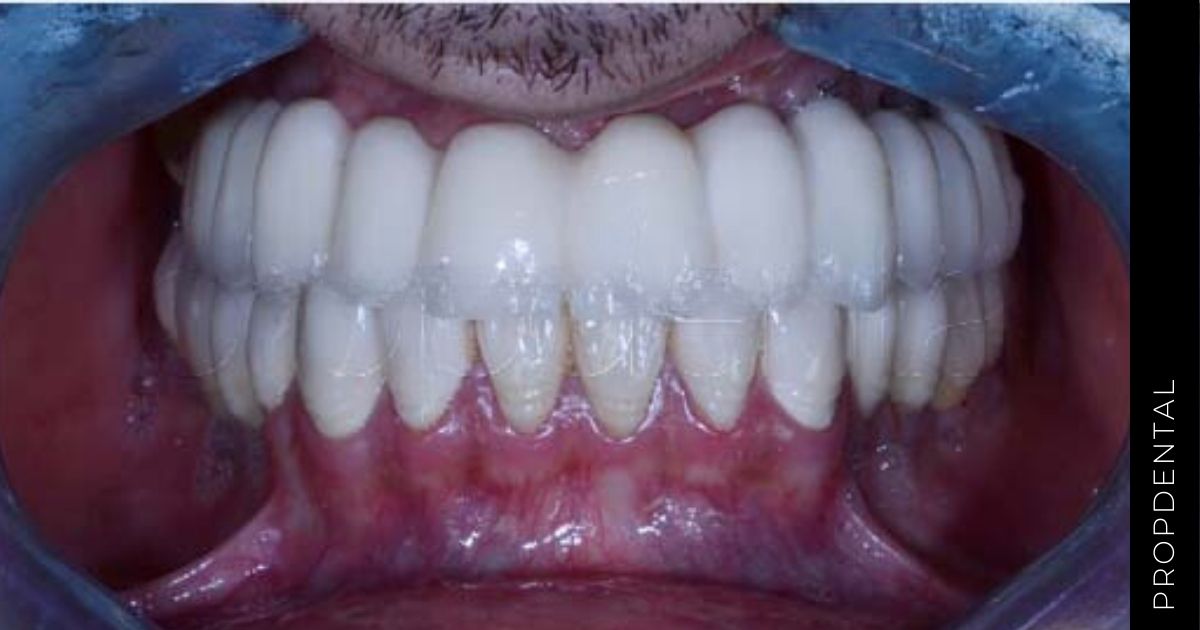 Implante osteointegrado