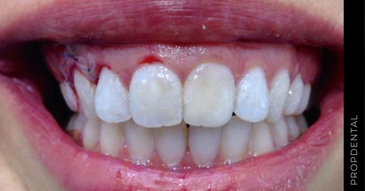 Indicaciones de la gingivectomia