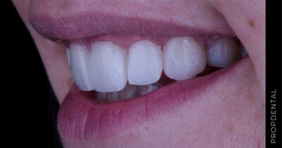 Indicaciones y contraindicaciones de las carillas dentales