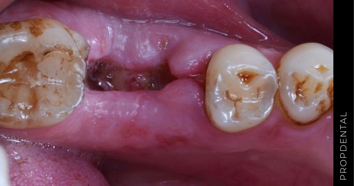 Infecciones dentales tras una extracción ¿Qué hacer?