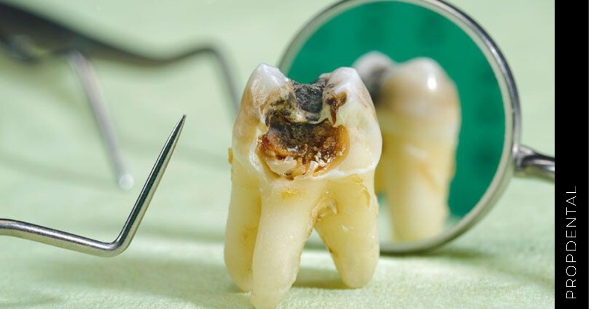 Infecciones odontogénicas: ¿Cuál es su origen?