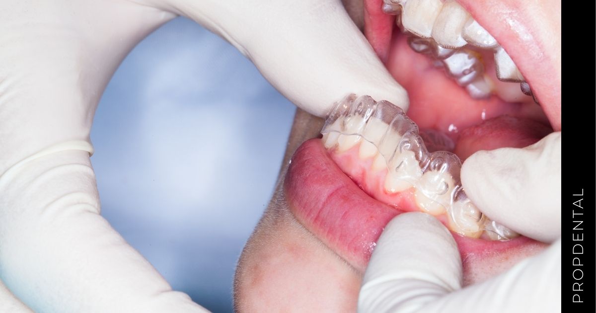 La importancia de utilizar retenedores de ortodoncia