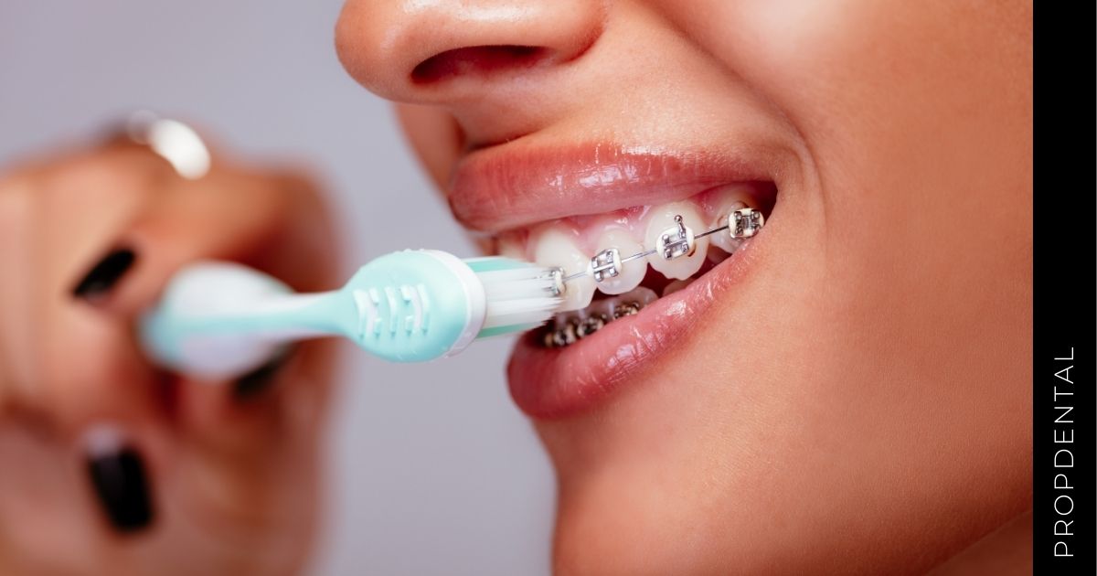 La importancia del cuidado dental con brackets y retenedores