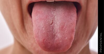 La lengua fisurada